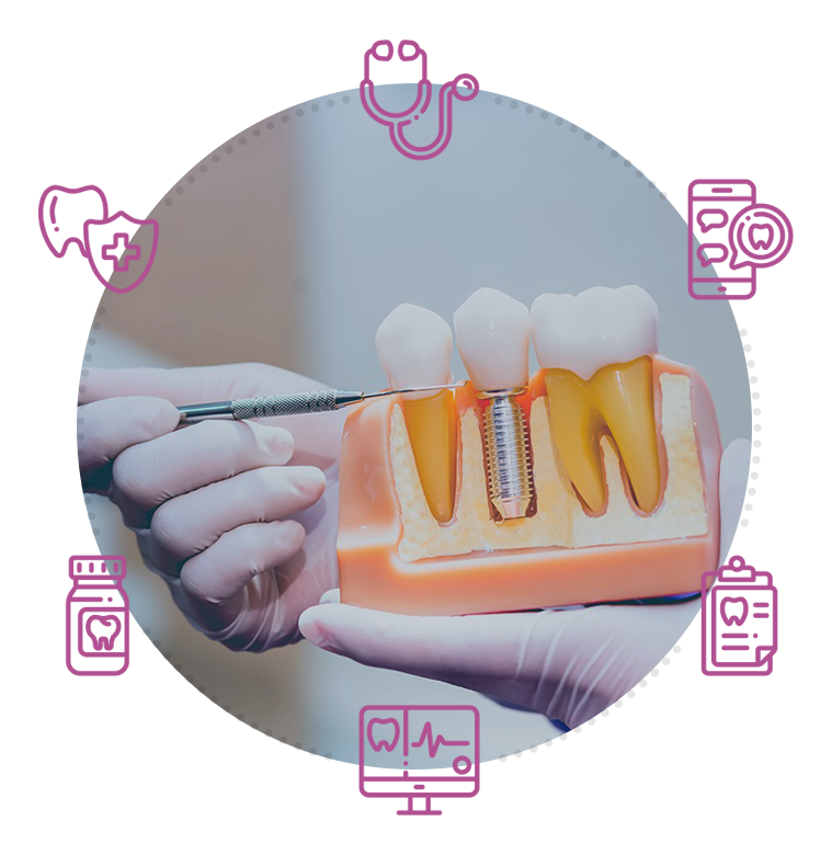 Dental Implants