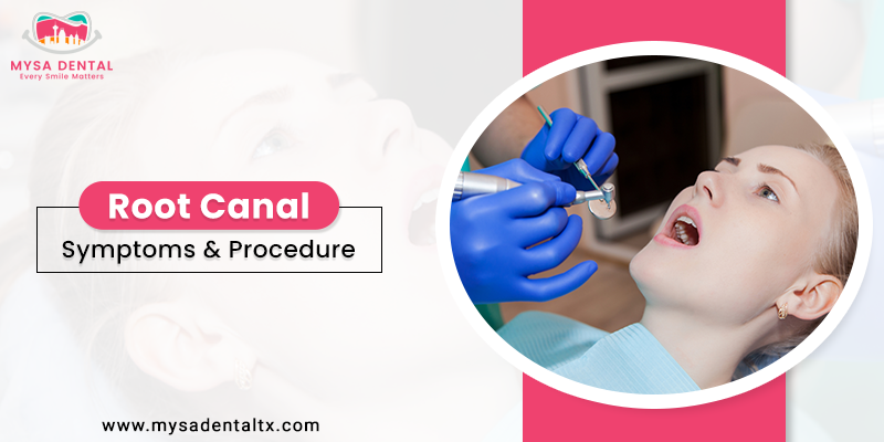 Root Canal: Symptoms & Procedure