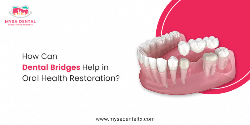 How Can Dental Bridges Help in Oral Health Restoration?