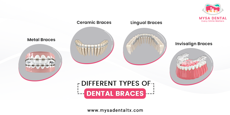 Dental Braces in San Antonio